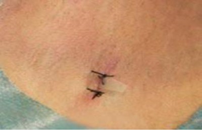 目前腋臭根治技术推广情况报告