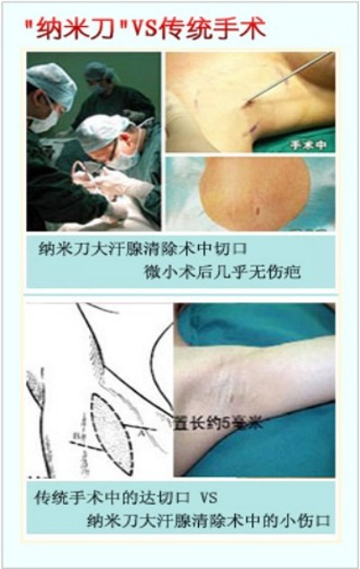 目前腋臭根治技术推广情况报告