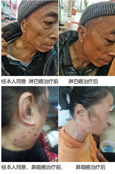 尿毒症乳腺癌 不讲价钱凭良心给广西百色杨忠雅