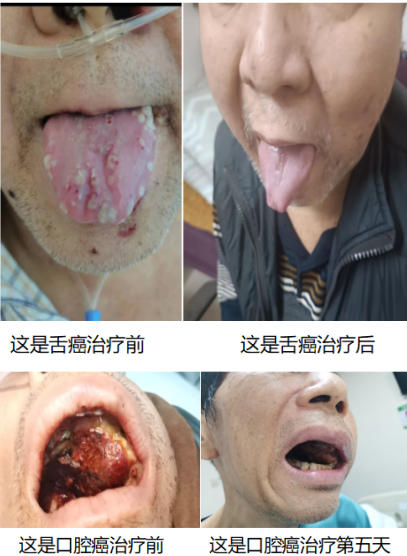 尿毒症乳腺癌 不讲价钱凭良心给广西百色杨忠雅